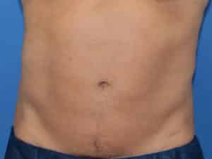 Real Patient truSculptFlex, Somenek + Pittman MD, Washington D.C.