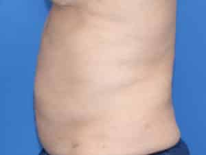 Real Patient truSculptFlex, Somenek + Pittman MD, Washington D.C.