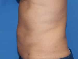 Real Patient truSculptFlex, Somenek + Pittman MD, Washington D.C.