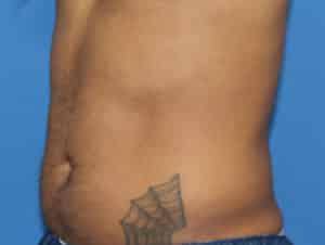 Real Patient truSculptFlex, Somenek + Pittman MD, Washington D.C.