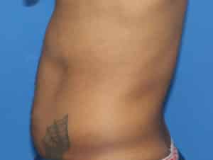 Real Patient truSculptFlex, Somenek + Pittman MD, Washington D.C.