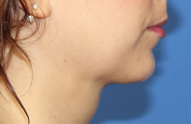 Real patient Neck Liposuction by Dr.Somenek, Washington D.C.