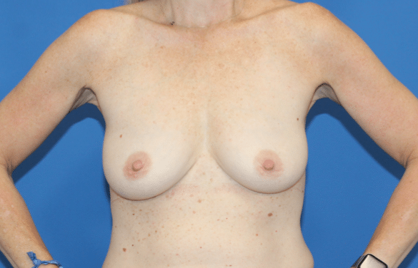 Real patient Mastopexy with Breast Augmentation by Dr.Pittman, Washington D.C.