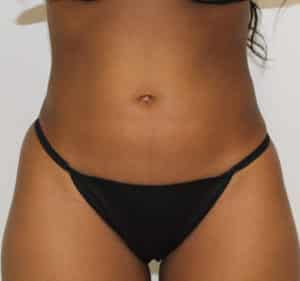 Real Patient Trusculpt ID, Somenek + Pittman MD, Washington D.C.