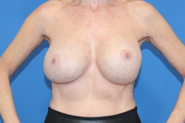 Real patient Revision Mastopexy Breast Lift and Breast Augmetnation by Dr.Pittman, Washington D.C.