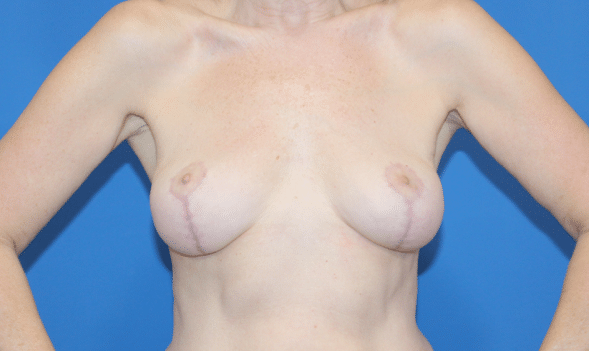 Real patient Mastopexy Breast Lift by Dr.Pittman, Washington D.C.