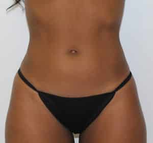 Real Patient Trusculpt ID, Somenek + Pittman MD, Washington D.C.
