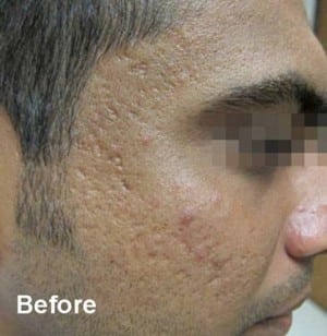 Real Patient Microneedling, Somenek + Pittman MD, Washington D.C.