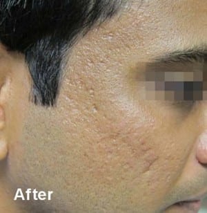 Real Patient Microneedling, Somenek + Pittman MD, Washington D.C.