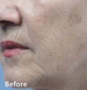 Real Patient Microneedling, Somenek + Pittman MD, Washington D.C.
