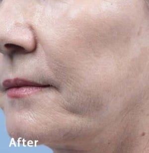 Real Patient Microneedling, Somenek + Pittman MD, Washington D.C.