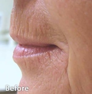 Real Patient Microneedling, Somenek + Pittman MD, Washington D.C.