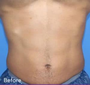 Real Patient truSculptFlex, Somenek + Pittman MD, Washington D.C.