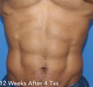 Real Patient truSculptFlex, Somenek + Pittman MD, Washington D.C.