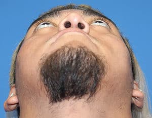 Real patient Rhinoplasty by Dr.Somenek, Washington D.C.