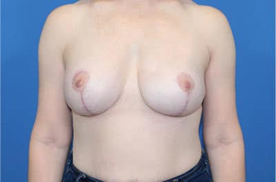 Real patient Revision Mastopexy Breast Lift and Breast Augmetnation by Dr.Pittman, Washington D.C.