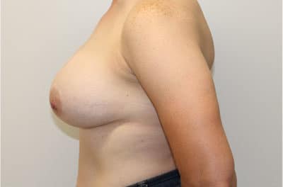 Real patient Revision Mastopexy Breast Lift and Breast Augmetnation by Dr.Pittman, Washington D.C.