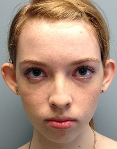 Real patient Otoplasty by Dr.Pittman, Washington D.C.