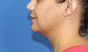 Real Patient SomenekMD Signature Lift, Somenek + Pittman MD, Washington D.C.