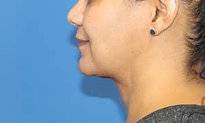 Real Patient SomenekMD Signature Lift, Somenek + Pittman MD, Washington D.C.