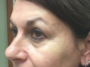 Real patient Filler, Somenek + Pittman MD, Washington D.C.