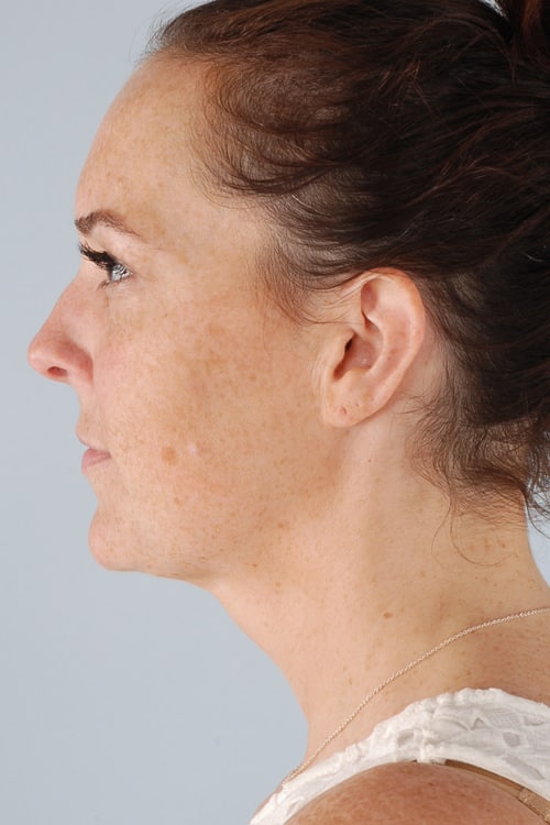 Real patient Neck Liposuction by Dr.Somenek, Washington D.C.