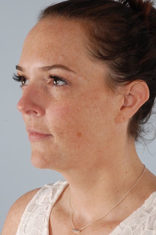 Real patient Neck Liposuction by Dr.Somenek, Washington D.C.