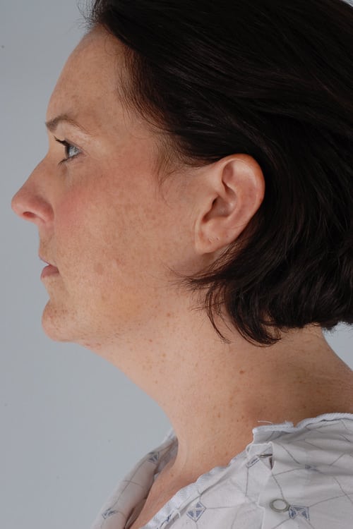 Real patient Neck Liposuction by Dr.Somenek, Washington D.C.