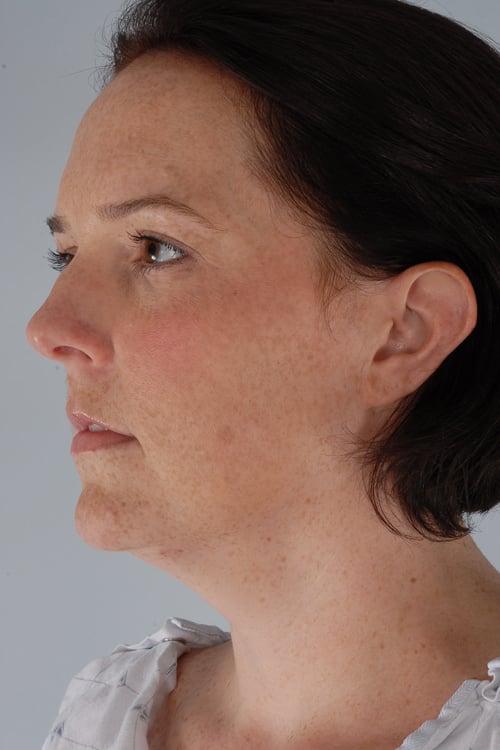 Real patient Neck Liposuction by Dr.Somenek, Washington D.C.