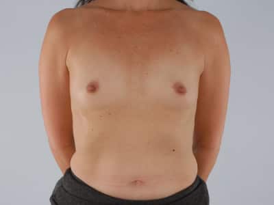 Real patient NIpple Reduction by Dr.Pittman, Washington D.C.