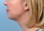 Real patient Facetite, Somenek + Pittman MD, Washington D.C.