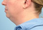 Real patient Facetite, Somenek + Pittman MD, Washington D.C.