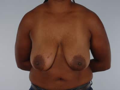 Real patient Mastopexy Breast Lift by Dr.Pittman, Washington D.C.