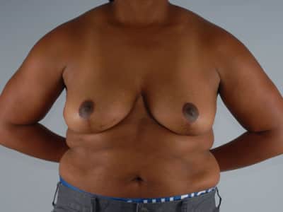Real patient Mastopexy Breast Lift by Dr.Pittman, Washington D.C.