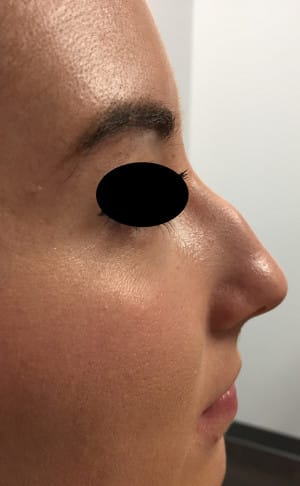 Real Patient SomenekMD Signature Lift, Somenek + Pittman MD, Washington D.C.
