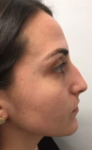 Real Patient SomenekMD Signature Lift, Somenek + Pittman MD, Washington D.C.