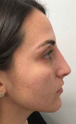 Real Patient SomenekMD Signature Lift, Somenek + Pittman MD, Washington D.C.