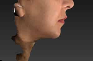 Real patient Facetite, Somenek + Pittman MD, Washington D.C.