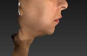 Real patient Facetite, Somenek + Pittman MD, Washington D.C.