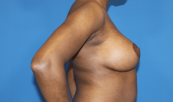 Real patient Mastopexy with Breast Augmentation by Dr.Pittman, Washington D.C.