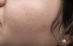 Real patient Acne Scar Treament, Somenek + Pittman MD, Washington D.C.