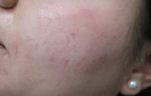 Real patient Acne Scar Treament, Somenek + Pittman MD, Washington D.C.