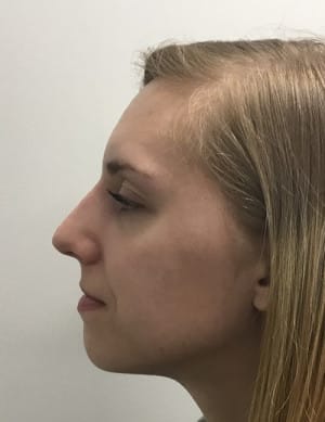 Real Patient SomenekMD Signature Lift, Somenek + Pittman MD, Washington D.C.