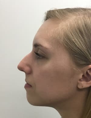 Real Patient SomenekMD Signature Lift, Somenek + Pittman MD, Washington D.C.