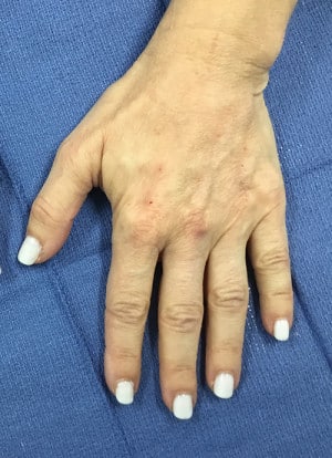 Real Patient Hand Rejuvenation, Somenek + Pittman MD, Washington D.C.