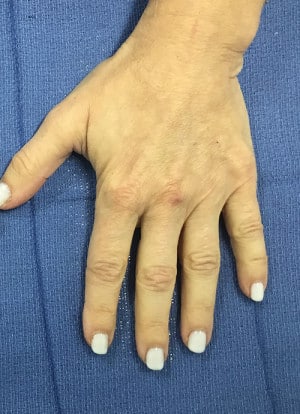Real Patient Hand Rejuvenation, Somenek + Pittman MD, Washington D.C.