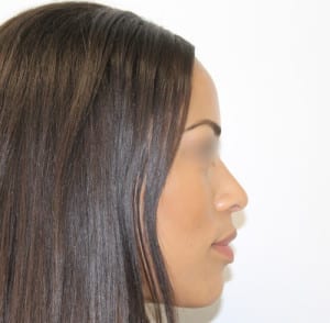 Real patient Rhinoplasty by Dr.Somenek, Washington D.C.