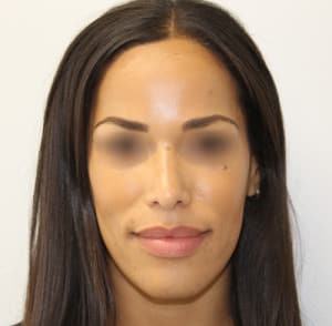 Real patient Rhinoplasty by Dr.Somenek, Washington D.C.