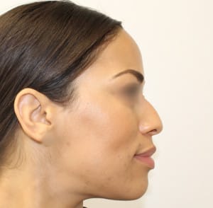 Real patient Rhinoplasty by Dr.Somenek, Washington D.C.