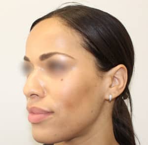 Real patient Rhinoplasty by Dr.Somenek, Washington D.C.
